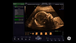 Voluson Signature Series: 3D/4D acquisition of fetal sup ...