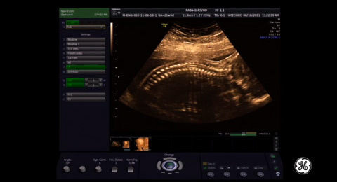 Voluson Signature Series: 3D/4D acquisition of the fetal spine