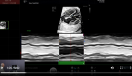 Voluson Fetal Heart - fetalHQ BT20 – Tracing Example (2020)