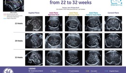 Fetal brain, from 22 to 32 weeks