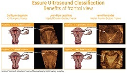Essure Ultrasound Classification Poster