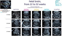 Le cerveau foetal, de 22 à 32 semaines