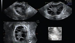 Sonography-based Automated Volume Count (SonoAVC)