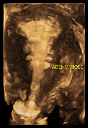 adenomyosis_1.jpg