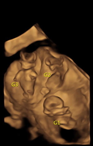 multiple-gestation-1.jpg