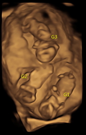 multiple-gestation-2.jpg