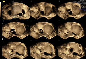 tomographic-ultrasound-imaing-tui-ovarian-mass.jpg