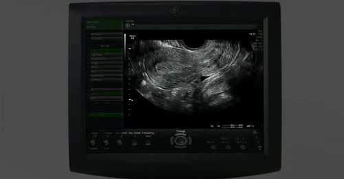 Voluson Performance Series: 3D Gynecology 