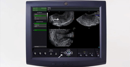Voluson Performance Series: 3D Gynecology