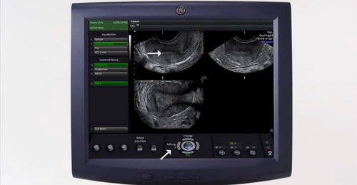 3D Gynecology