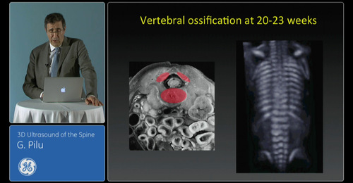 Advanced VISUS - 3D Ultrasound of the spine