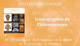 Adénomyose  Poster Gyn FR