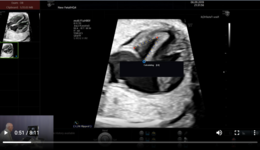 Voluson Fetal Heart - fetalHQ BT20 – Example of Incorrect Tracing (2020)