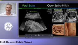 ISUOG 2020 - Case Studies of New Transducer RM7C - Prof. Dr. Chaoui