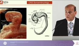 ISUOG 2017- Evaluating CNS in 2nd trimester using e4D Dr. ...