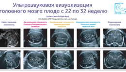 Fetal Neurosonogrpahy (RU)
