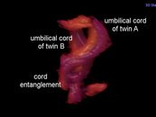 Doctor Captures Live Image of Twins with Entangled Umbilical ...