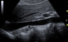 Ultrasound Evaluation of Renal Artery Stenosis