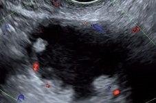 Ultrasound in Gynecological Oncology