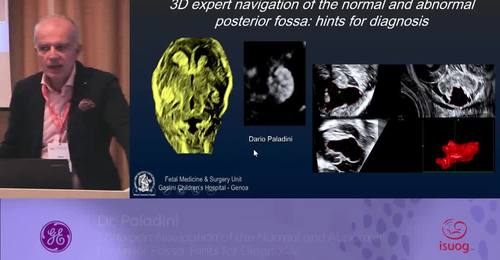 ISUOG 2016 Meet the Expert: Dr Paladini- 3D Expert Navigation of the Normal and Abnormal Posterior Fossa