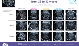 Fetal Brain, from 22 to 32 Weeks (EN)