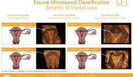 Essure Ultrasound Classification (EN)