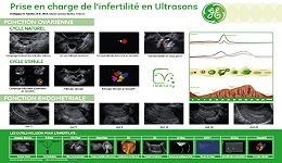 Prise en charge de l’infertilité en Ultrasons