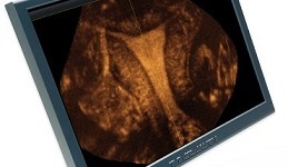 3D ultrasound for uterine exploration