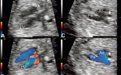 Early four-dimensional echocardiography