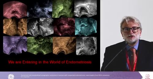  ISUOG 2017- Ultrasound in endometriosis IDEA consensus Dr S Guerriero 