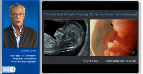 Dr. Benoit: The Fetal First Trimester Anatomy- Normal and ...