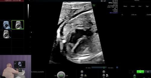 Voluson Fetal Heart - fetalHQ Case Study - Increased Left ...