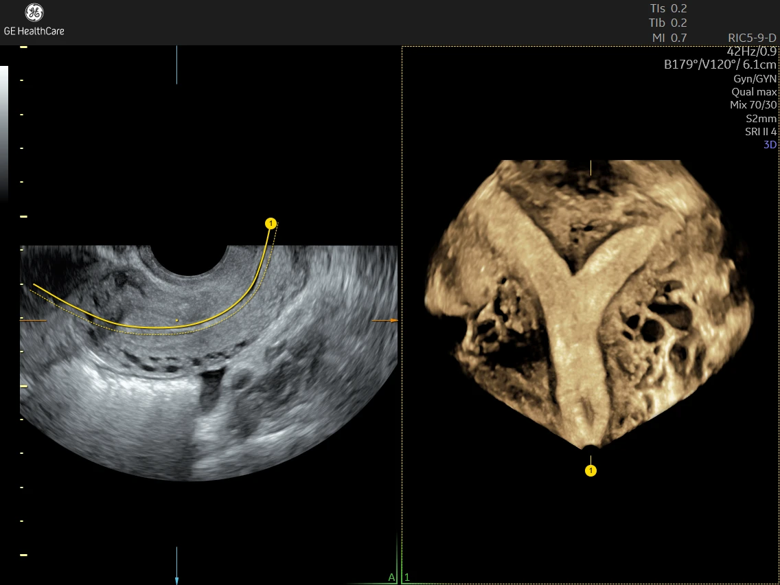Septate uterus  