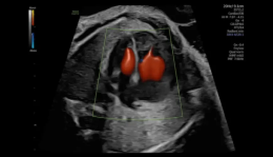 Fetal Cardiac Screening Echo Course
