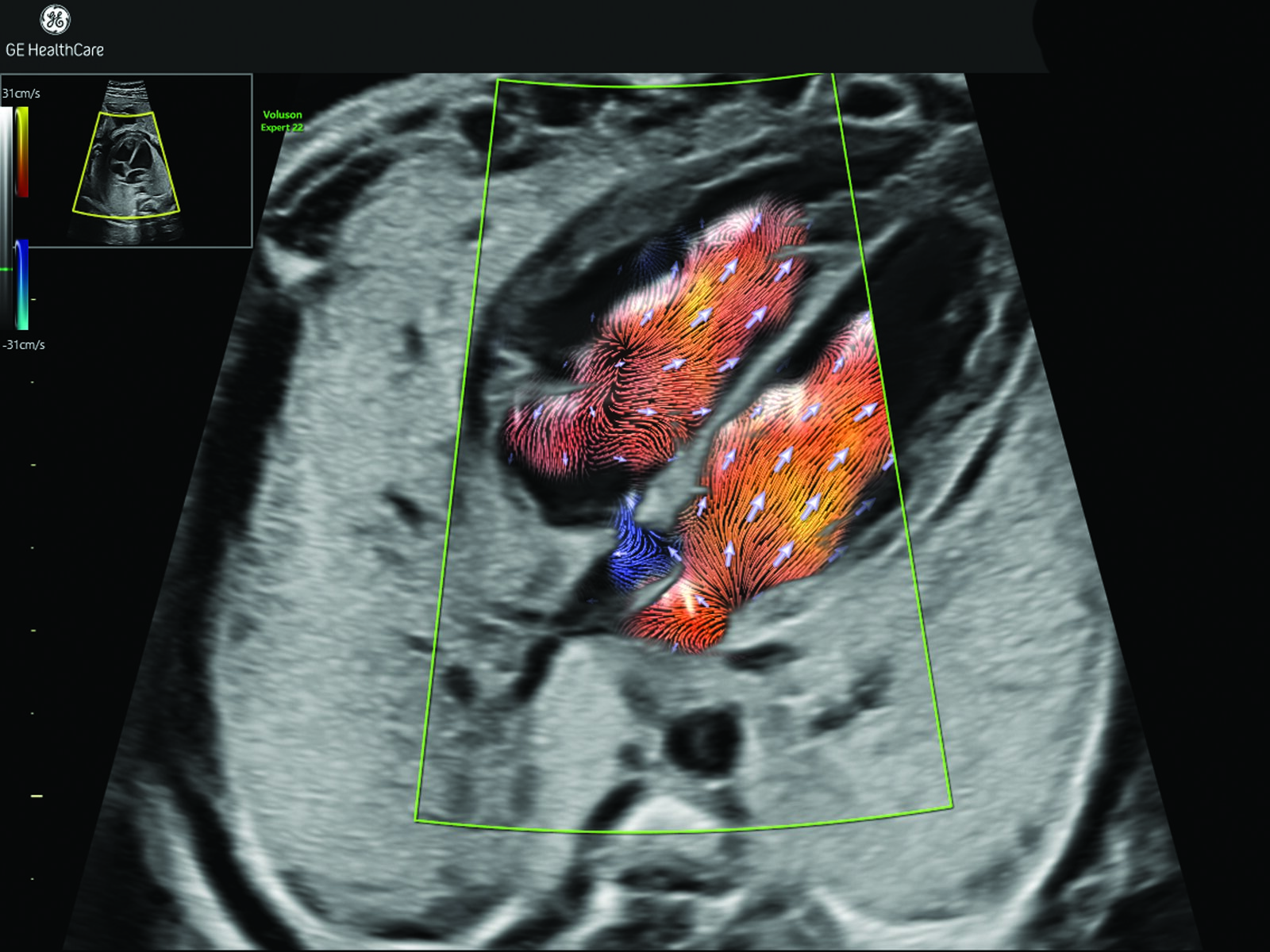 Join Us at SMFM 2026: Voluson™ Club Clinical Program Highlights