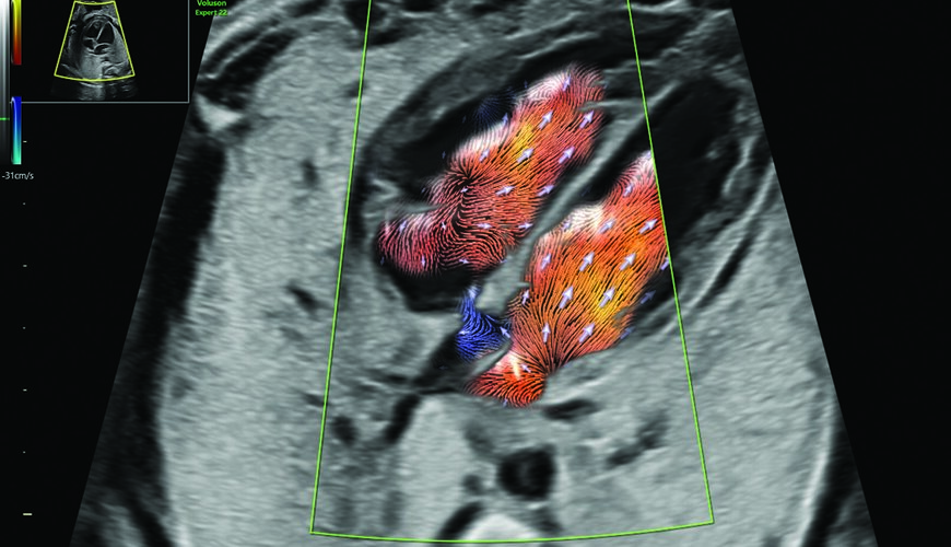 Join Us at SMFM 2026: Voluson™ Club Clinical Program Highlights